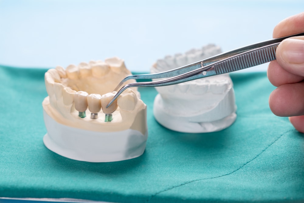 Implant-Supported Bridge dental implants leesburg Dr. Zack Mekouar. Russell Branch Dental. Veneers, Teeth Whitening Traditional Braces (Metal and Ceramic), Invisalign, Root Canals, Wisdom Teeth Removal, Emergency Dental Services in Leesburg, VA 20175